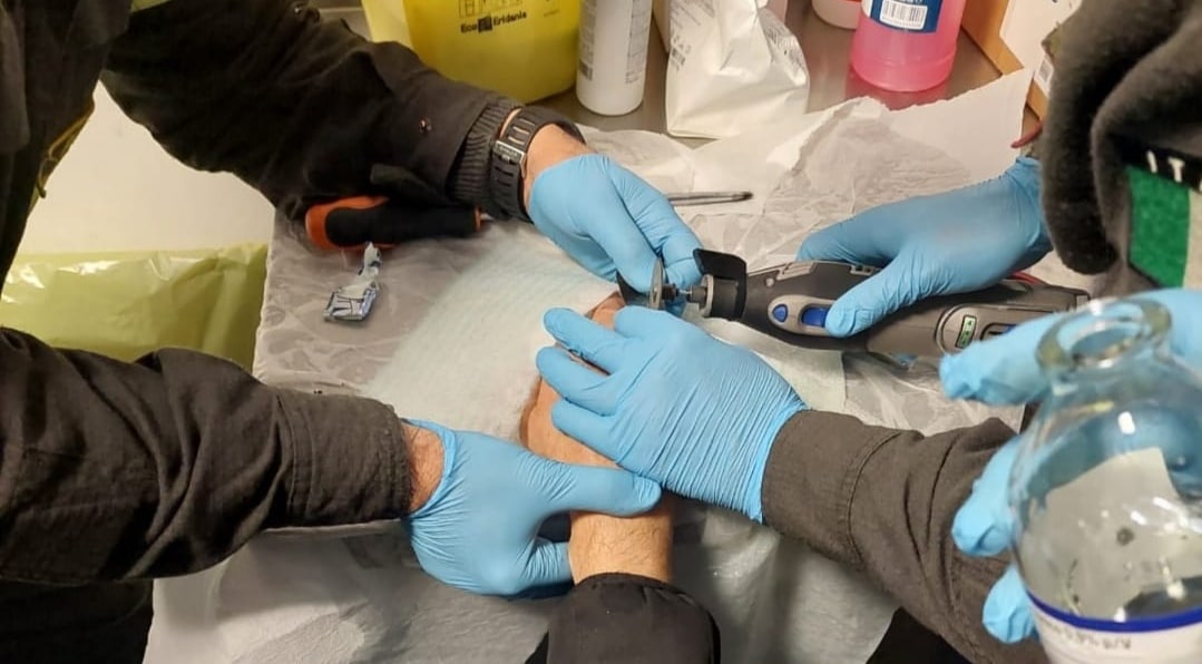 Genova. Anello incastrato al dito, per sfilarlo arrivano i pompieri